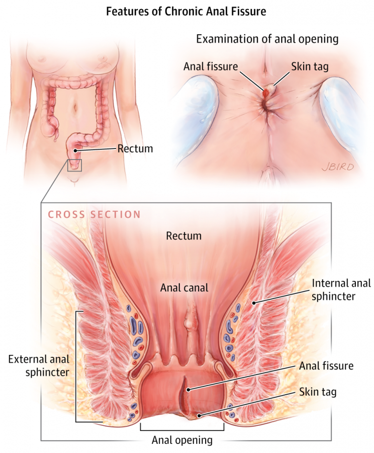 ANAL FISSURE