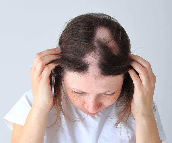 ALOPECIA