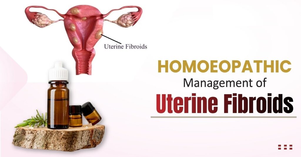 Homoeopathic Management of Uterine Fibroids