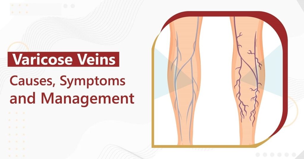 Varicose Veins: Causes, Symptoms, and Management