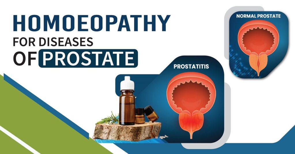 Homoeopathy for Diseases of Prostate