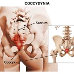 Top 6 Homeopathic Medicines for Coccydynia