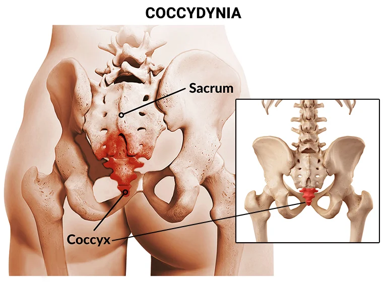 Top 6 Homeopathic Medicines for Coccydynia