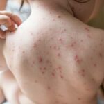 Natural Treatment of Chickenpox with Homeopathy