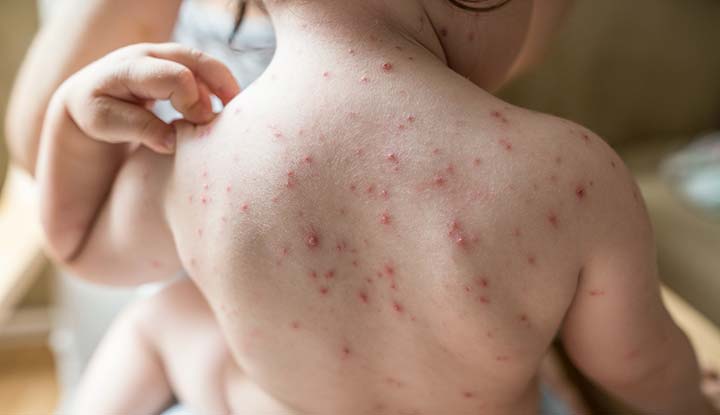 Natural Treatment of Chickenpox with Homeopathy