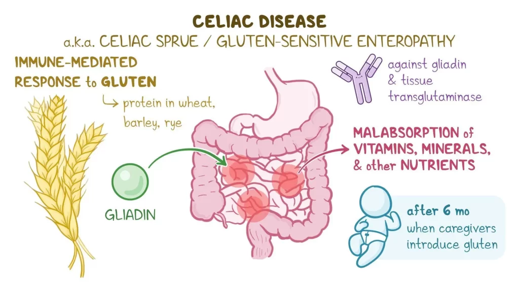 Homeopathic Treatment for Celiac Disease