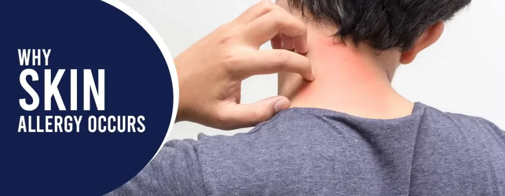Why Skin Allergy Occurs?